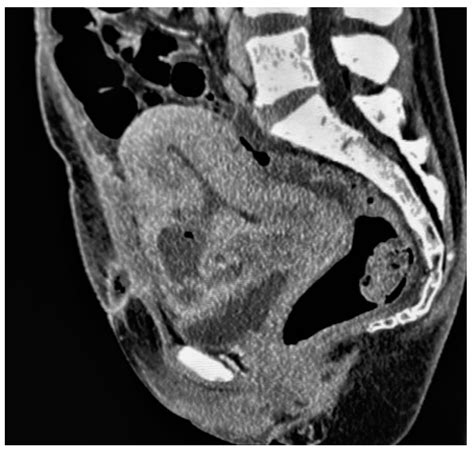 Imaging of Acute Abdominopelvic Pain in Pregnancy and Puerperium—Part I ...