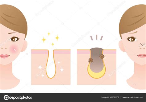 Clogged Pore On Nose