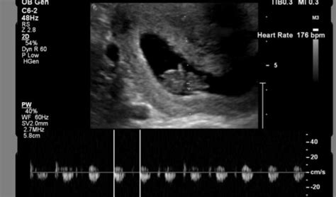 Mioma uterino | BabyCenter