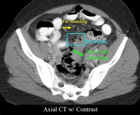 Image result for Colonic Diverticulum CT