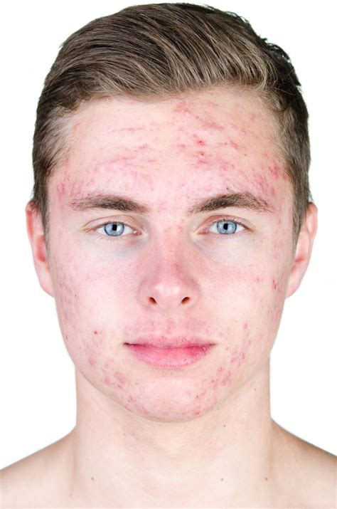 How to use Benzoyl Peroxide on Pimples – Cosmetics and you : Acne Treatment, Careprost Eyelashes ...