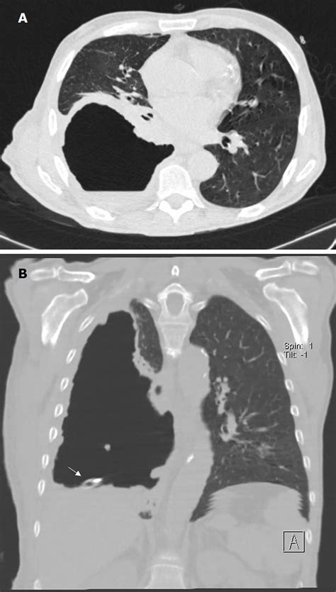 Image result for Painful Giant Abscess Exploding