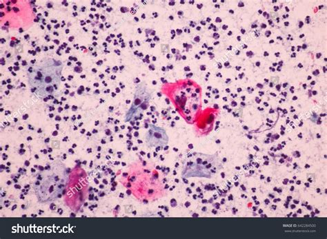 Abnormal Squamous Epithelial Cells View Microscopy Stock Photo (Edit ...