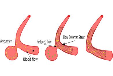 Endovascular treatment of arterial aneurysm /pseudoaneurysm - Dr ...