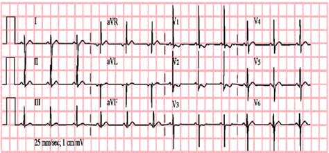 Right Venrticular Hypertrophy Due To Ostium Secundum Or Sinus Venous ...