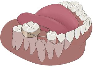 Space Maintainer | Dental Square | Best dentist and dental clinic in ...