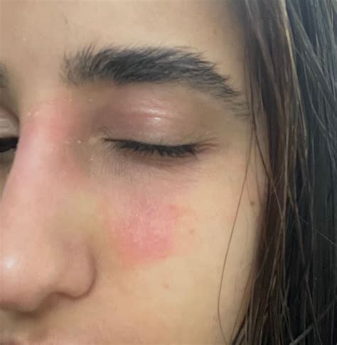 Bed Bug Bites On Eyelid