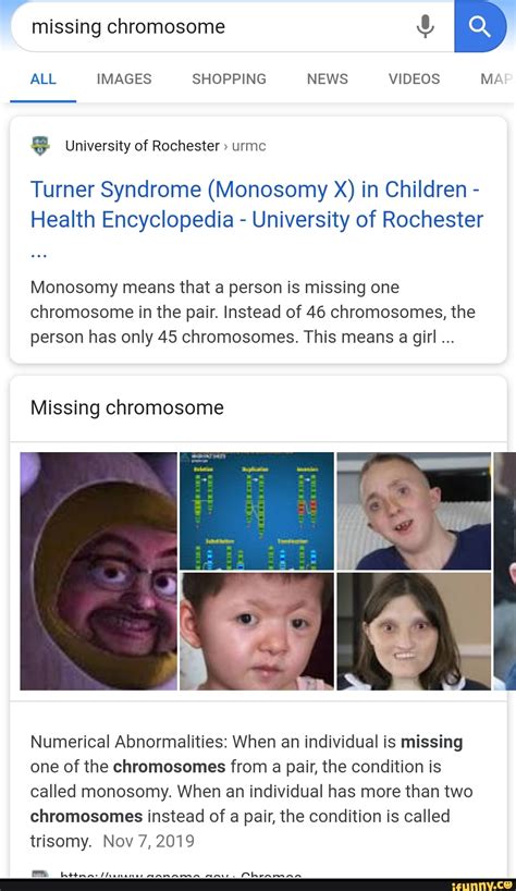 Monosomy X