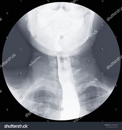 Esophageal Achalasia Wikipedia