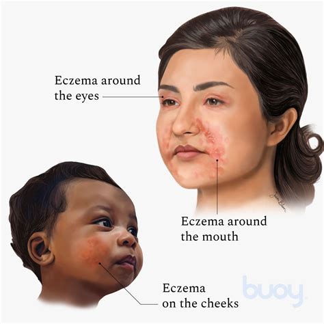 Eczema Face Causes Eczema Of The Face And Neck | Eau Thermale Avène