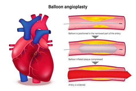 PCI Treatment 的图像结果