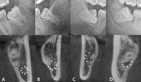 AI-powered 3D models based on CBCT may predict injury risk to Inferior ...