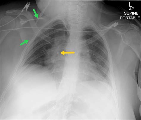 Delta Shunt Valve X Ray at Cynthia Burris blog