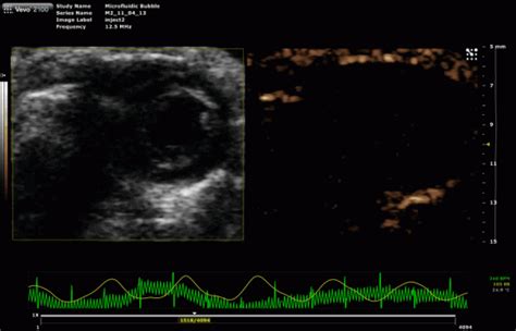 Image result for Definity Microbubbles