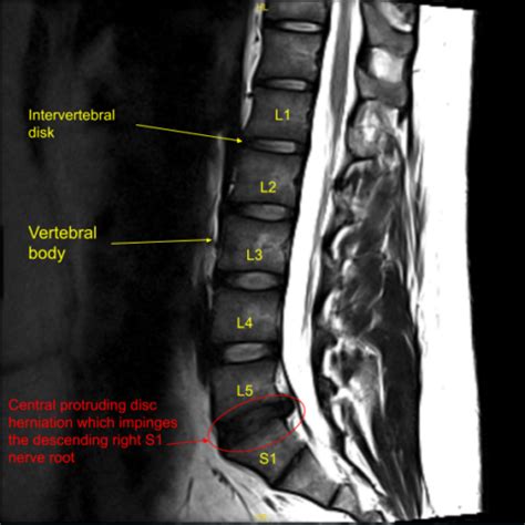 Image result for Selective Nerve Root Block vs Transforaminal