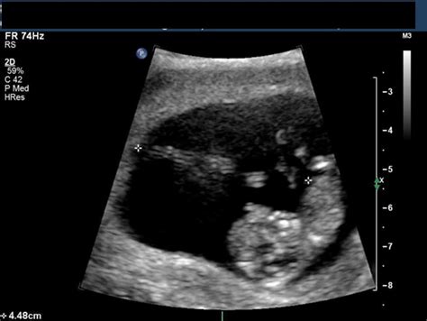 Bildergebnis für normal umbilical cord ultrasound