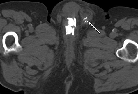 CT and MR Imaging Features of Artificial Urinary Sphincters, Penile Prostheses, and Other ...