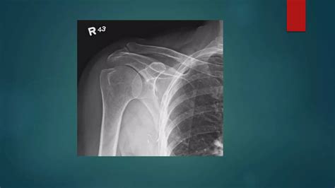 Acromioclavicular joint arthritis | PPTX