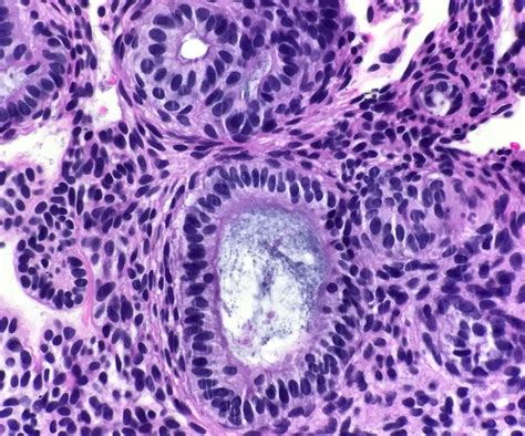 Pathology Outlines - Adenomatoid odontogenic tumor