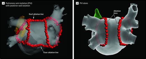 Effect of Catheter Ablation Using Pulmonary Vein Isolation With vs ...