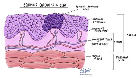 Squamous Cell Carcinoma In Situ Histology