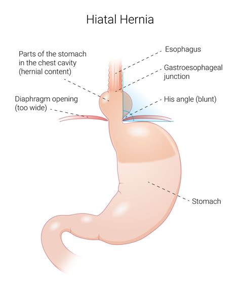 Reflux Disease - Reflux Surgery - Center for Visceral Surgery and ...