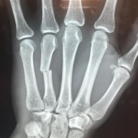 Broken Hand X Ray
