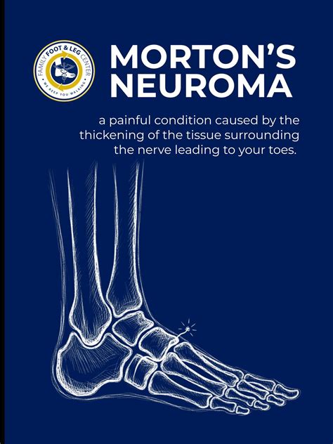 Morton’s Neuroma: Understanding the Pain in the Ball of Your Foot - NaplesPodiatrist