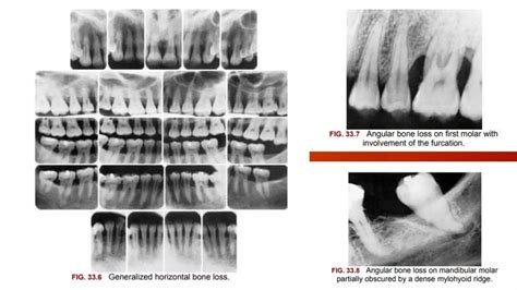 RADIOGRAPHIC EXAMINATIONS OF BONE LOSS AND PATTERN OF BONE LOSS | PPTX