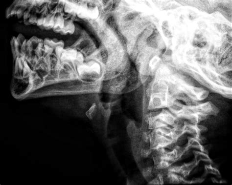 Broken Neck X Ray - neck x ray