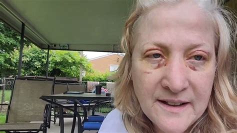 Image result for Levator Resection Surgery