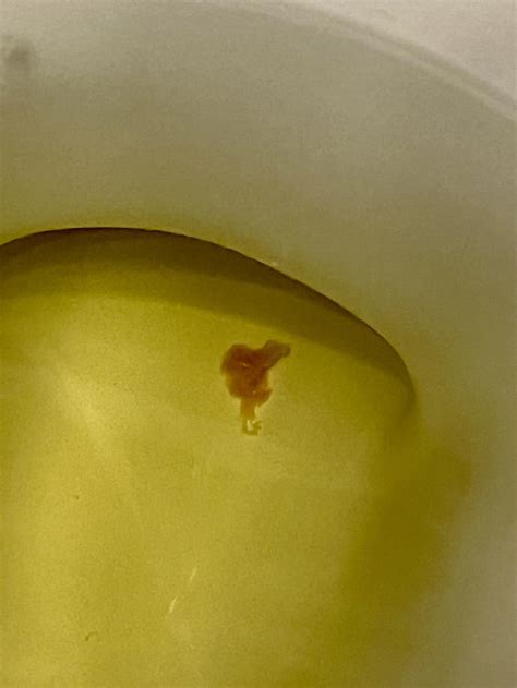 Fleshy piece of tissue discharge every time with urination : r/medical