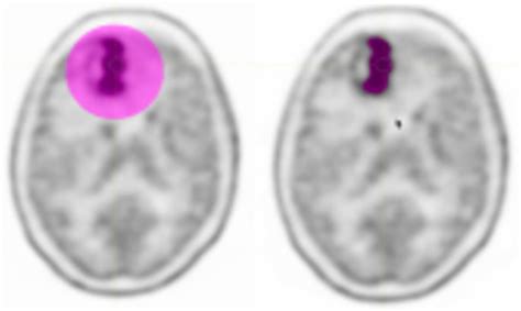 Feasibility on the Use of Radiomics Features of 11[C]-MET PET/CT in ...