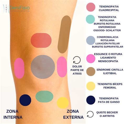 Dolor de rodilla: ¿Qué puede ser? - DeniFisio