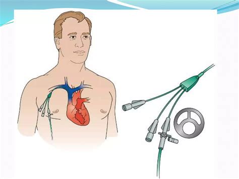 Central venous access catheter – Artofit