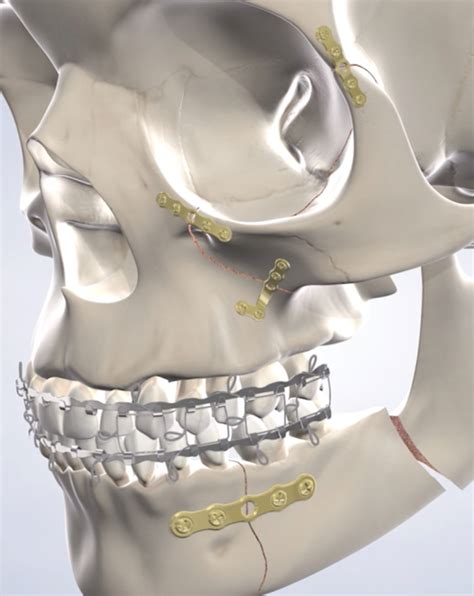 Facial Trauma in Feasterville, Newtown, and Abington, PA