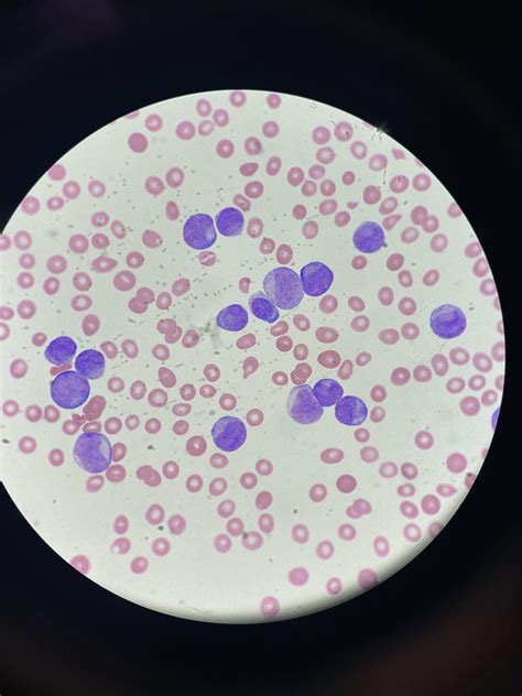 Cells! Blasts? Immature Granulocytes? : r/medlabprofessionals