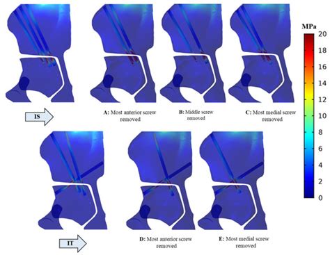 Comparative Biomechanical Study of Screw Fixation Techniques in ...