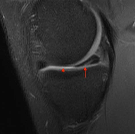 Bucket-handle Tear of the Meniscus - Radsource