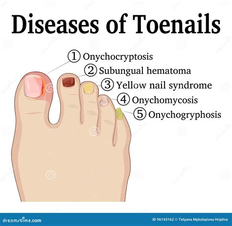 Onychogryphosis Clipart And Illustrations