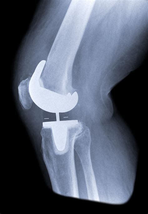 Knee Replacement | Knee Arthroplasty | MedlinePlus