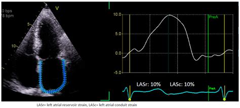 The Clinical Applications of Left Atrial Strain: A Comprehensive Review ...
