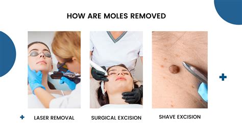 Mole Removal: How Much Does It Cost?