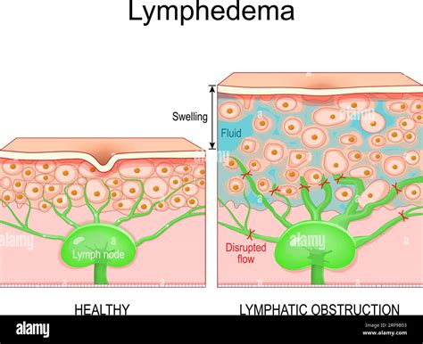 Lymphedema Diagram
