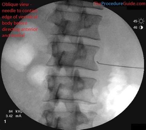 Image result for Fluoro Spinal Injection