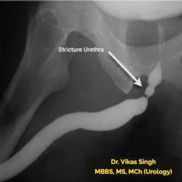 Stricture Urethra Treatment in Indore — Causes, Symptoms & Best ...