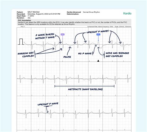 Premature Ventricular Contraction (PVC) Vs. Premature Atrial ...