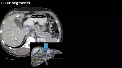 LIVER SEGMENT ANATOMY CT SCAN | PPTX