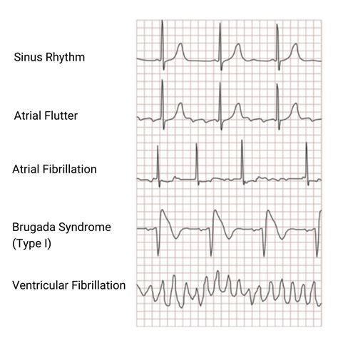 What is shockable rhythm? - Cardiovisual | CardioVisual posted on the ...