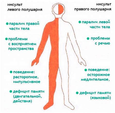 Левосторонний и правосторонний инсульт. Какой опаснее? Доктор Позвонков
